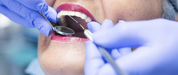 Best Knocked-Out Tooth (Avulsed Tooth) Treatment in Milford Square, PA